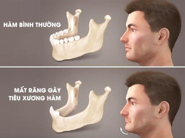 Đi khám răng định kỳ, thiếu nữ 17 tuổi tình cờ phát hiện "vật thể lạ" trong xương hàm và căn bệnh di truyền nguy hiểm suýt bị bỏ quên!- Ảnh 1.