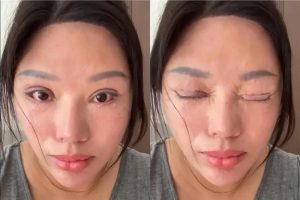 Người phụ nữ 6 năm không thể nhắm mắt khi ngủ, lý do phía sau khiến nhiều người bất ngờ