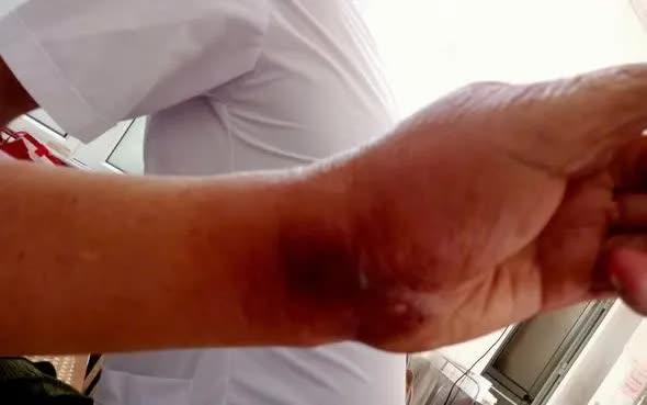 Cảnh báo nguy cơ nhiễm trùng, nhiễm độc nặng khi tiếp xúc với côn trùng độc - Ảnh 1.