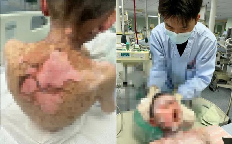 Bé trai 9 tuổi bong tróc da, loét khắp cơ thể, vảy dính kín mắt miệng, nguyên nhân từ 1 loại thuốc thông dụng trong mọi gia đình- Ảnh 1.