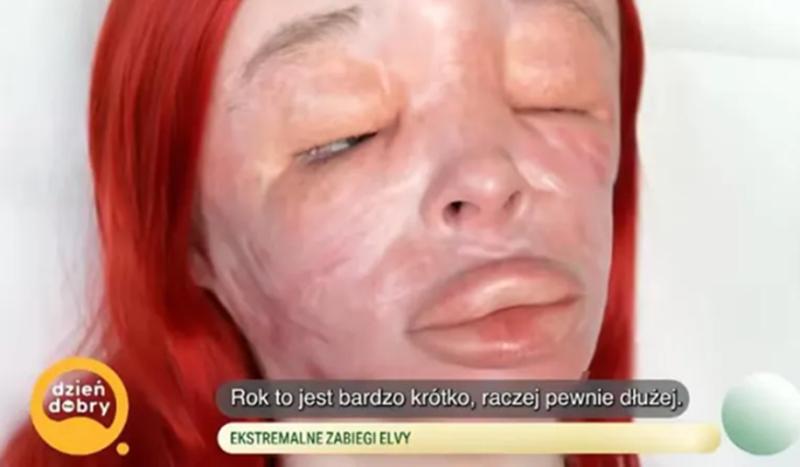 Cô gái 26 tuổi khuôn mặt sưng phù và cứng đờ vì nghiện 1 thứ nhiều chị em rất ưa chuộng- Ảnh 2.