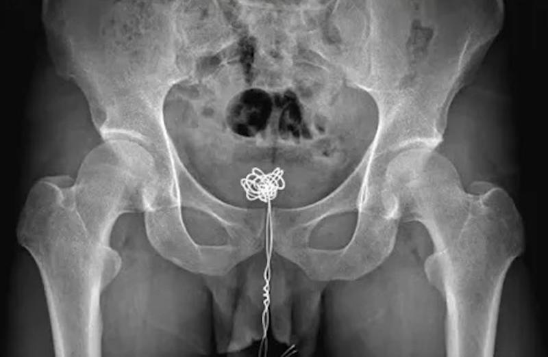 Chàng trai 28 tuổi đau bụng dưới, muốn đi tiểu nhưng không thể đi được, bác sĩ kiểm tra phát hiện 1 thứ dài 25cm bên trong- Ảnh 2.