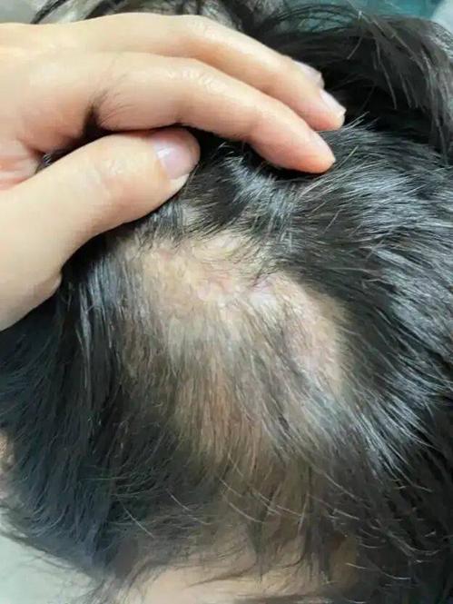 Bé gái 5 tuổi rụng tóc hói vĩnh viễn cả 1 mảng vì 1 hành động tưởng chừng vô hại- Ảnh 1.