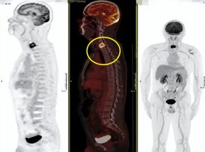 Người đàn ông sốt nhẹ 2 tháng, bác sĩ phát hiện đốt sống cổ bị "đục thủng": Thủ phạm giấu trong căn bếp nhiều gia đình