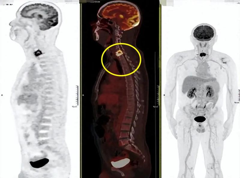 Người đàn ông sốt nhẹ 2 tháng, bác sĩ phát hiện đốt sống cổ bị "đục thủng": Thủ phạm giấu trong căn bếp nhiều gia đình- Ảnh 1.