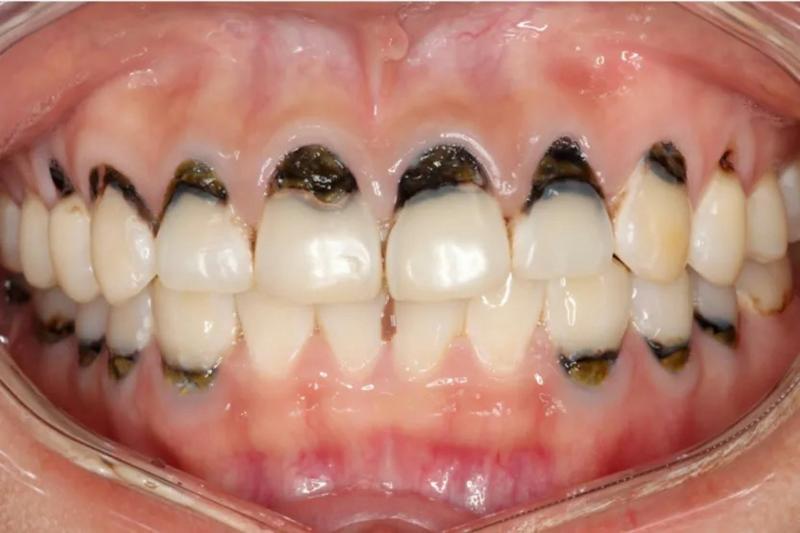 Người phụ nữ 30 tuổi cả hàm chân răng đen sì, mùi hôi nồng nặc vì 1 loại nước vạn người mê- Ảnh 2.