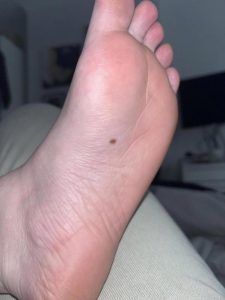 Xem nhẹ nốt ruồi ở nơi cực hiếm ai để ý, người phụ nữ "hối không kịp" vì ung thư đã di căn