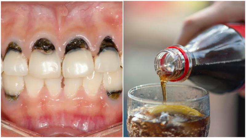 Người phụ nữ 30 tuổi cả hàm chân răng đen sì, mùi hôi nồng nặc vì 1 loại nước vạn người mê- Ảnh 1.