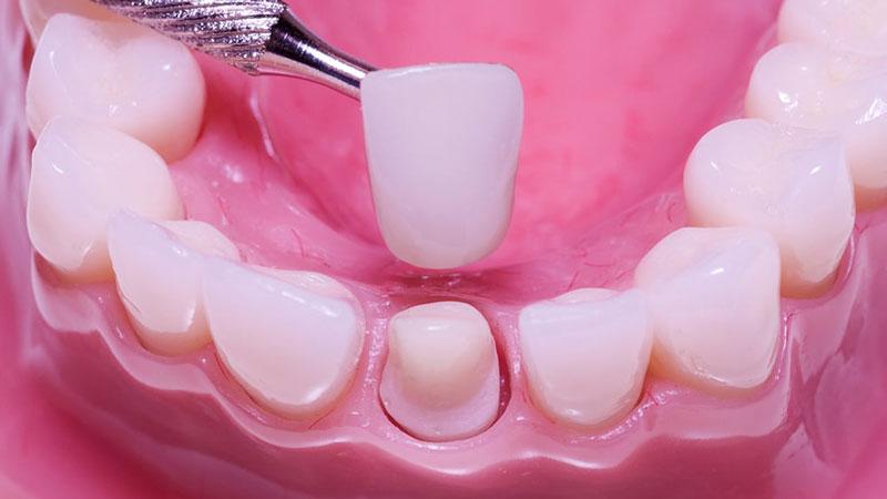 Vì sao nhiều người bọc răng sứ xong bị hôi miệng? - Ảnh 1.