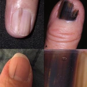 Bác sĩ ung bướu nói thẳng: Móng tay có 4 thứ này trong người "giấu" ung thư, khám mau còn kịp