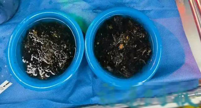 Bé gái 10 tuổi đau bụng suốt 3 năm, bố mẹ sốc khi bác sĩ lấy ra thứ "đáng sợ" trong bụng- Ảnh 2.