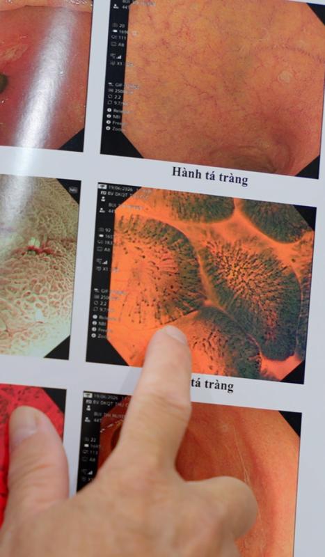 Vì sao cùng là kết quả "bình thường" nhưng nội soi đường tiêu hóa bằng máy phóng đại 520 lần đáng tin cậy hơn 135 lần?- Ảnh 3.