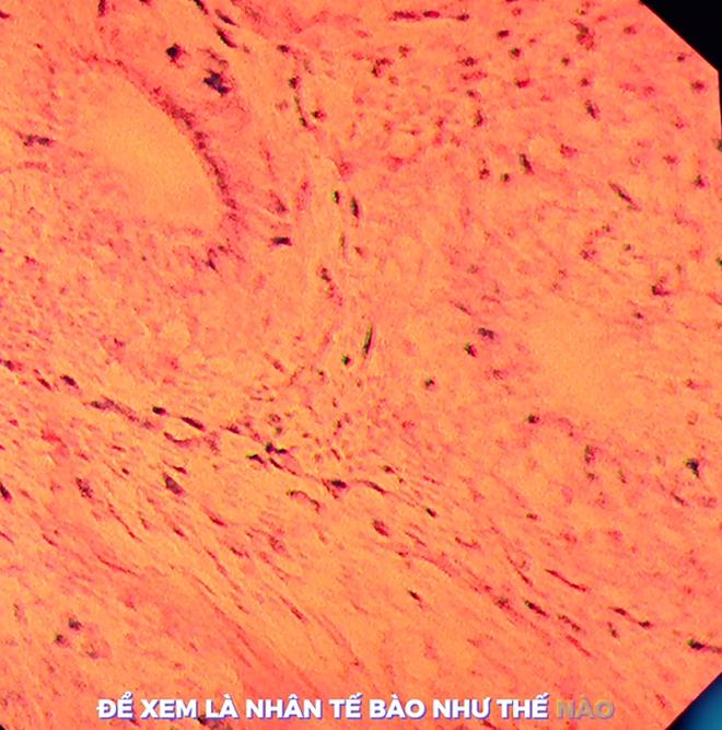 Vì sao cùng là kết quả "bình thường" nhưng nội soi đường tiêu hóa bằng máy phóng đại 520 lần đáng tin cậy hơn 135 lần?- Ảnh 5.