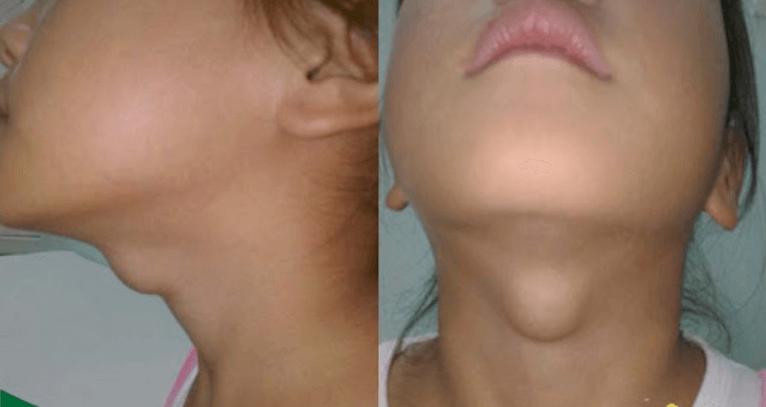 Một nhà 3 người cùng mắc ung thư tuyến giáp: "Thủ phạm" là món rau nhiều người tưởng ăn càng nhiều càng khỏe- Ảnh 3.