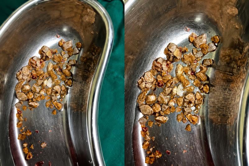 Nam kỹ sư 35 tuổi nhập viện vì sỏi chất đầy thận sau khi bỏ trà sữa, uống thứ nước lành mạnh để giảm cân- Ảnh 3.