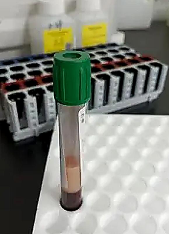 Người đàn ông 40 tuổi có "máu trắng đục như sữa", bác sĩ cảnh báo thói quen "sướng miệng, hại thân" - Ảnh 1.