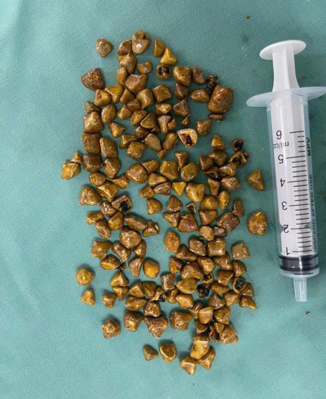 Người phụ nữ 39 tuổi đau bụng dữ dội, bác sĩ gắp ra thứ "đáng sợ" trong ổ bụng - Ảnh 2.