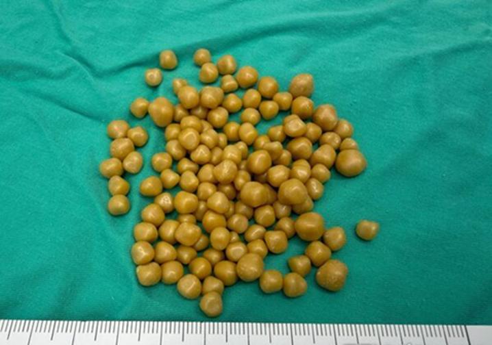 Người phụ nữ 38 tuổi đau bụng suốt 1 tháng, đi khám bác sĩ phát hiện “khối u bí ẩn” chứa 130 viên sỏi trông như “bọc trứng cá”- Ảnh 2.
