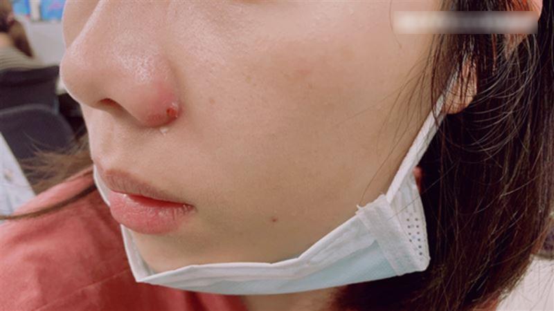 Nặn mụn quanh miệng, người phụ nữ bị sưng tấy từ môi lên tận sống mũi, bác sĩ cảnh báo: Sai lầm ở 1 điểm!- Ảnh 1.