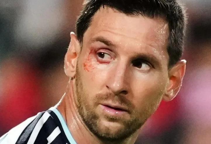 Vì sao Messi "tơi tả", rách cả mí mắt?- Ảnh 1.