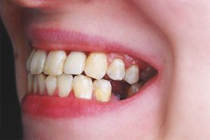 Vì sao nhiều người mất răng nhưng không chịu trồng?