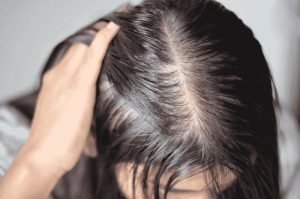 Tưởng stress vì thi cử nên rụng tóc, cô gái 22 tuổi phát hiện căn bệnh đang âm thầm đang phá hủy thận