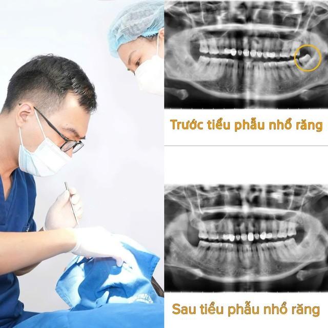 Tâm sự của một bác sĩ chuyên ngành Răng Hàm Mặt: "Điều tôi muốn lấy đi không chỉ là chiếc răng khôn, mà là nỗi sợ của bệnh nhân"- Ảnh 3.