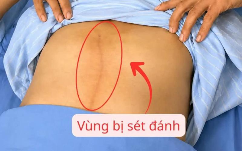 Thoát nguy kịch sau khi bị sét đánh lúc đang lao động - Ảnh 1.
