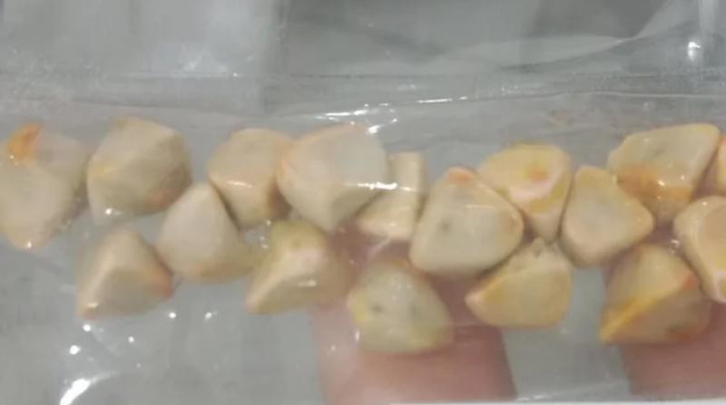 Uống trà đá đều đặn suốt 10 năm, người phụ nữ sốc khi bác sĩ lấy ra thứ "đáng sợ" trong bụng- Ảnh 1.