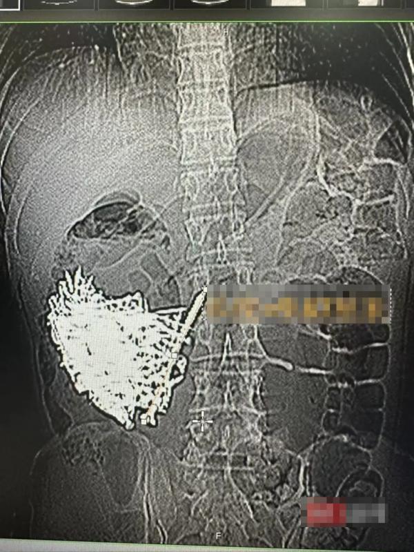 Phẫu thuật lấy ra hơn 1kg đinh sắt, đồng xu, ốc vít trong dạ dày một người đàn ông - Ảnh 2.