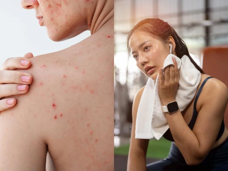 Chăm skincare kỹ nhưng lưng vẫn nổi đầy mụn? Bác sĩ da liễu chỉ ra 1 thói quen nhiều người mắc phải khiến mụn mãi không dứt- Ảnh 1.