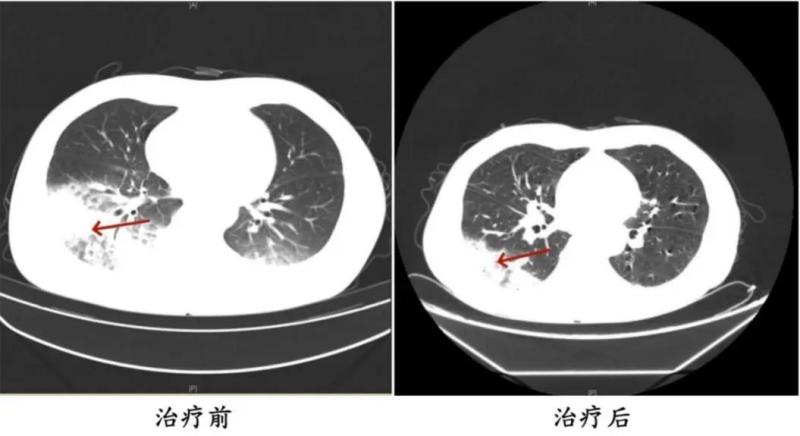 Bật điều hòa ngủ, người phụ nữ sốt cao liên tục, phổi tổn thương hơn một nửa: Bác sĩ cảnh báo mối nguy ít ai ngờ ngay trong nhà- Ảnh 2.