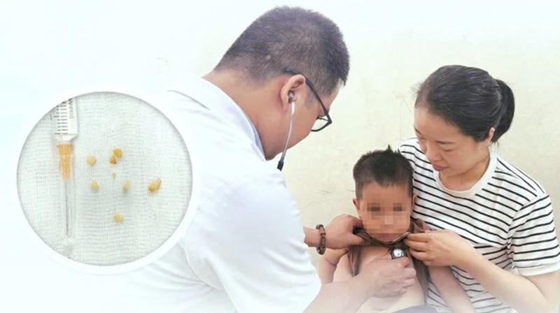 Bé trai 2 tuổi ho sặc dữ dội, tím tái sau ăn lạc theo cách "vạn người mê" - Ảnh 1.