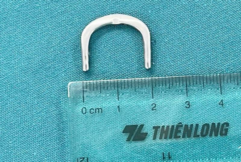Bé 3 tuổi đau bụng, bác sĩ phát hiện “vật lạ” mắc trong tá tràng - Ảnh 2.