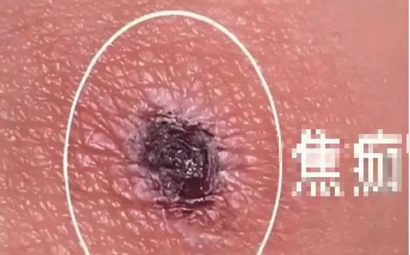 Người phụ nữ 56 tuổi nguy kịch vì nốt đen "lạ" mọc trên người - Ảnh 1.