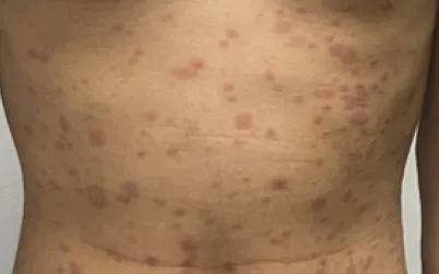 Quan hệ tình dục không an toàn, nam thanh niên phát hiện đồng nhiễm giang mai và HIV - Ảnh 1.