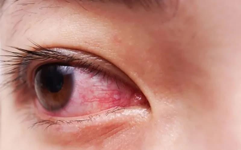 Đau mắt đỏ mùa mưa: Chủ động phòng bệnh, ngăn ngừa lây lan - Ảnh 1.