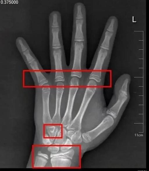 Bé gái 9 tuổi nhưng tuổi xương đã đạt tới 12 tuổi, bác sĩ cảnh báo thói quen gây dậy thì sớm cho trẻ ở nhiều gia đình - Ảnh 1.