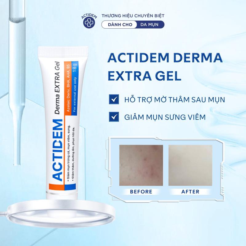 Mụn không chỉ là câu chuyện tuổi dậy thì - Ảnh 3.