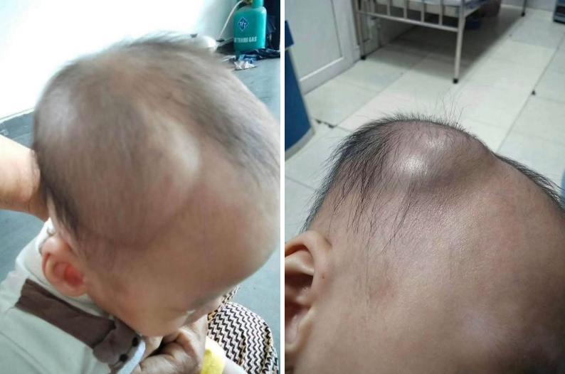 1 mẹ bỉm chia sẻ diễn biến âm thầm nhưng nguy hiểm sau cú ngã của con: Đừng chủ quan kể cả khi bé có vẻ vẫn bình thường- Ảnh 1.