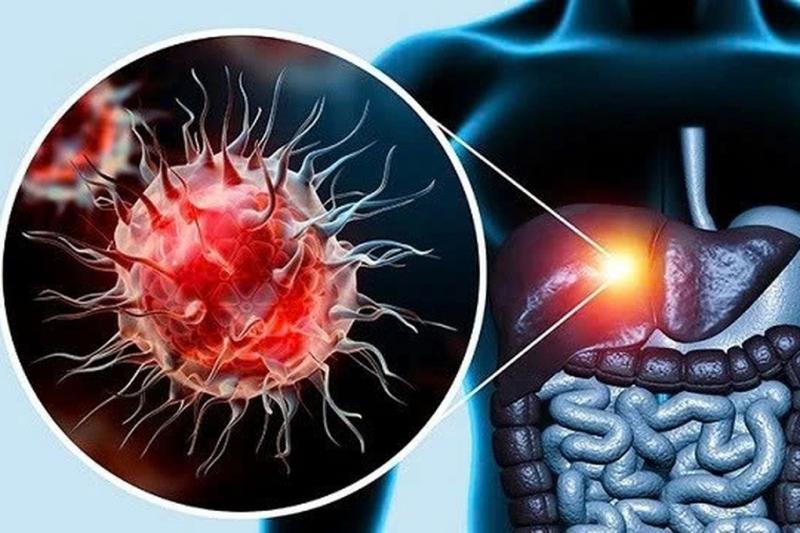 Không rượu bia, gan vẫn có thể tổn thương nặng vì lý do ít ai ngờ - Ảnh 1.