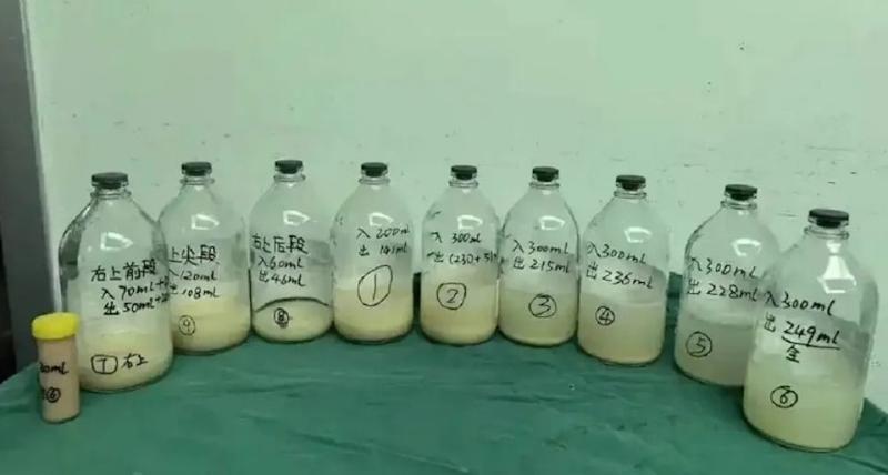 Bé gái 6 tuổi ho suốt 2 tháng, phổi chứa đầy dịch trắng như sữa: Bác sĩ lên tiếng cảnh báo- Ảnh 1.