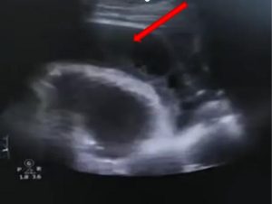 Người đàn ông 50 tuổi “tim suýt chết đuối” chỉ vì gãi 1 nốt nhọt