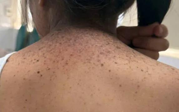 Khô da sắc tố ở trẻ: Cảnh báo nguy cơ ung thư da sớm - Ảnh 1.
