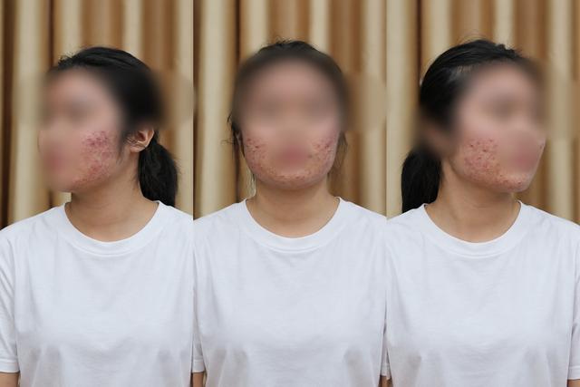 Làm đẹp cấp tốc mùa tựu trường, nhiều nữ sinh mặt sưng như ong đốt- Ảnh 1.