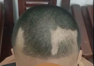 Đã cắt tóc '3 phân' nhưng nam sinh lớp 6 vẫn nhổ trụi từng mảng vì áp lực ôn thi