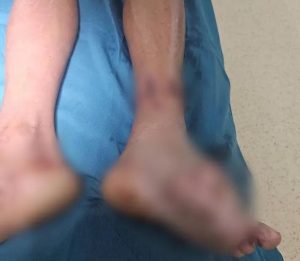 Đắp cả gói bột ngọt vào vết thương, ngư dân suýt phải cắt cụt cẳng chân