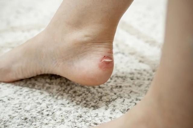 Bé gái sốt 39,3 độ C suốt 2 ngày, nhập viện mới phát hiện thủ phạm là 1 miếng băng cá nhân- Ảnh 2.
