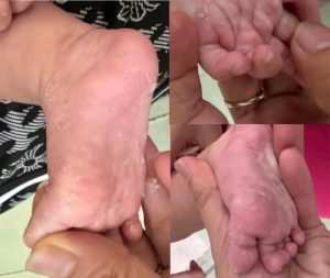 Trẻ nhập viện vì giang mai bẩm sinh, 5 ca biến chứng viêm màng não