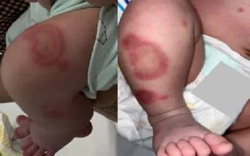Lupus sơ sinh ở trẻ 26 ngày tuổi, cảnh giác biến chứng tim - Ảnh 1.